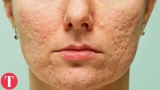 10 Things You Didn’t Know About ACNE